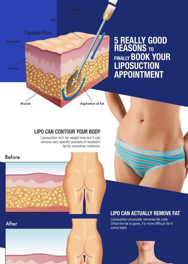 Lipo